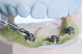 Dental implant temporary abutment