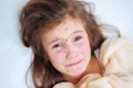 Closeup of cute sad crying little girl in bed. Varicella virus or Chickenpox bubble rash on child Royalty Free Stock Photo