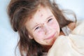 Closeup of cute sad crying little girl in bed. Varicella virus or Chickenpox bubble rash on child Royalty Free Stock Photo