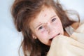 Closeup of cute sad crying little girl in bed. Varicella virus or Chickenpox bubble rash on child Royalty Free Stock Photo