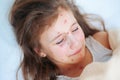 Closeup of cute sad crying little girl in bed. Varicella virus or Chickenpox bubble rash on child Royalty Free Stock Photo