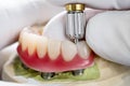 Dental implants supported overdenture.