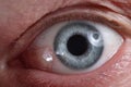 Closeup of diseased eye with red dilated vessels Royalty Free Stock Photo