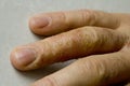Closeup of Eczema Dermatitis on man hand and fingers. Skin peeling,desquamation of hand, gray modern background. Hand dermatitis, Royalty Free Stock Photo