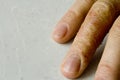 Closeup of Eczema Dermatitis on man hand and fingers. Skin peeling,desquamation of hand, gray modern background. Hand dermatitis, Royalty Free Stock Photo