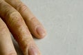 Closeup of Eczema Dermatitis on man hand and fingers. Skin peeling,desquamation of hand, gray modern background. Hand dermatitis, Royalty Free Stock Photo