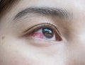 Closeup eye of asian woman with broken capillaries in the eye Royalty Free Stock Photo