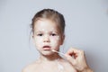 Closeup face of cute little girl with varicella virus or chickenpox bubble rash, doctor`s or mom`s hand with cotton swab coverin