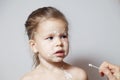 Closeup face of cute little girl with varicella virus or chickenpox bubble rash, doctor`s or mom`s hand with cotton swab coverin