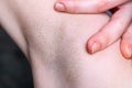 Closeup of female armpit after epilation with irritation. Royalty Free Stock Photo