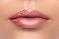 Closeup of female lips affected by herpes virus Royalty Free Stock Photo