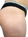 Closeup of female thighs with stretch marks Skin problem, entry for theme, explosive weight and diet, diabetes risk Royalty Free Stock Photo