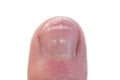 Closeup of a Fingernail with leukonychia Royalty Free Stock Photo