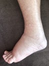 Foot of diseased female patient who suffers from edema illness