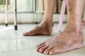 Closeup of foot,old elderly with swollen leg,dry skin of feet,cracks on the skin,lack of moisture,senior patient with beriberi,