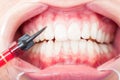 Closeup of front view of patient teeth durring treatment Royalty Free Stock Photo