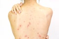 Closeup of girl back of Varicella virus or Chicken Pox on white Royalty Free Stock Photo