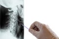 Closeup of the hand of a man in a white medical glove who holds a pointer and shows the spine on an X-ray. A picture of the Royalty Free Stock Photo