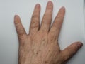 Closeup of a hand with a skin graft