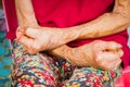Closeup hands of old woman suffering from leprosy, amputated han Royalty Free Stock Photo