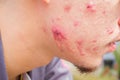 Closeup horizontal photo of male cheek with big pimple or acne a Royalty Free Stock Photo