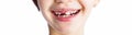 Closeup horizontal portrait of smiling child with changing milk teeth. Childhood, child, dental concept. Healthy changing teeth on