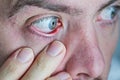 Closeup of human eye that is red and irritated. Symptom of dry eyes