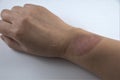 Burn scar on forearm on white background