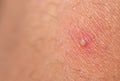 Closeup of ingrown hair