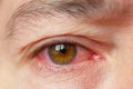 Closeup irritated infected red bloodshot eyes, conjunctivitis