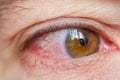 Closeup irritated infected red bloodshot eyes, conjunctivitis