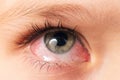 Closeup irritated infected red bloodshot eyes, conjunctivitis