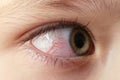 Closeup irritated infected red bloodshot eyes, conjunctivitis Royalty Free Stock Photo