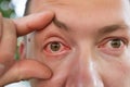 Closeup irritated infected red bloodshot eyes, conjunctivitis. Inflammation of the eyes in men Royalty Free Stock Photo