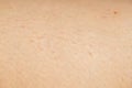 Irritated skin and ingrown hair after shaving legs Royalty Free Stock Photo