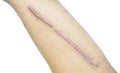 Closeup keloid scar on Asian man skin after femur fracture, broken thigh on white background