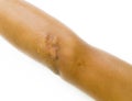 Closeup keloid scar on elbow of Asian man skin after motorcycle accident on white background Royalty Free Stock Photo