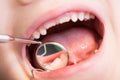 Closeup of kid or child mouth at dentist