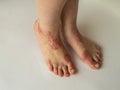 Closeup of the legs of a woman suffering from chronic psoriasis on a white background. Closeup of rash and scaling on the patient Royalty Free Stock Photo