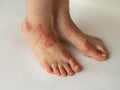 Closeup of the legs of a woman suffering from chronic psoriasis on a white background. Closeup of rash and scaling on the patient Royalty Free Stock Photo