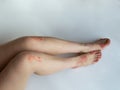 Closeup of the legs of a woman suffering from chronic psoriasis on a white background. Closeup of rash and scaling on the patient Royalty Free Stock Photo