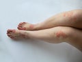 Closeup of the legs of a woman suffering from chronic psoriasis on a white background. Closeup of rash and scaling on the patient Royalty Free Stock Photo