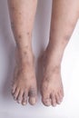 Closeup of the legs of a woman suffering from chronic psoriasis on a white background. Closeup of rash and scaling on the patient