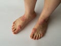 Closeup of the legs of a woman suffering from chronic psoriasis on a white background. Closeup of rash and scaling on the patient Royalty Free Stock Photo