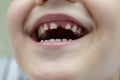 Closeup of little boy with missing teeth
