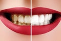 Closeup Macro of Female Teeth Before and After Whitening. Dental Health and Oral Care Concept. Happy Smile with Red Lips