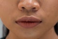 Body Part mouth lip acne wart skin close up woman