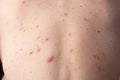 Closeup a man back who having varicella blister or chickenpox Royalty Free Stock Photo