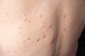 Closeup a man back who having varicella blister or chickenpox Royalty Free Stock Photo
