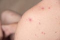 Closeup a man back who having varicella blister or chickenpox Royalty Free Stock Photo